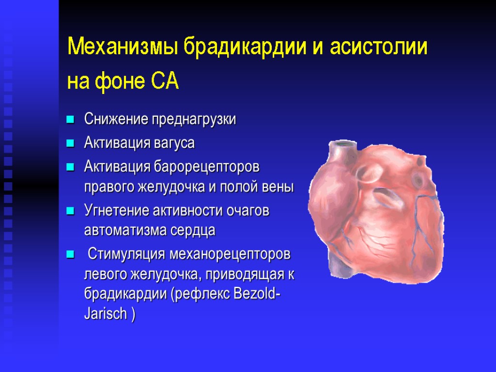 Механизмы брадикардии и асистолии на фоне СА Снижение преднагрузки Активация вагуса Активация барорецепторов правого